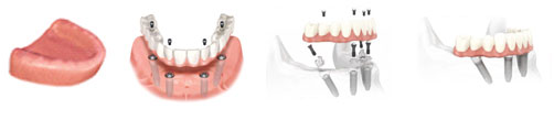 Tooth Implants